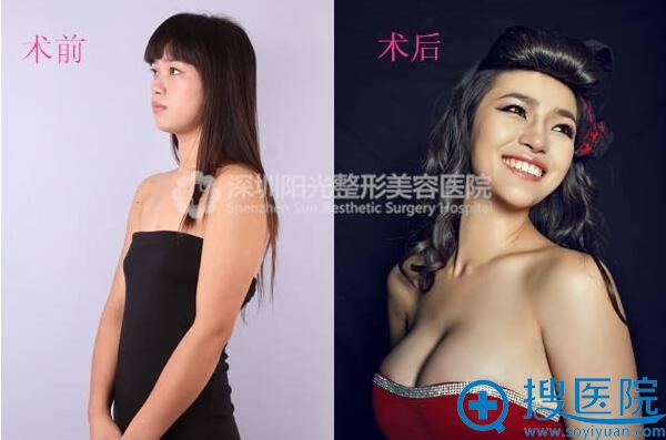 <!--<i data=20240710 data-id=12045></i>-->整形美容医院隆胸术后对比图 <!--<i data=20240710 data-id=12045></i>-->整形美容医院隆胸术后对比图