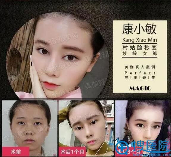 重庆美伽刘怀朴做鼻子好看吗?多个鼻综合案例见证医生实力