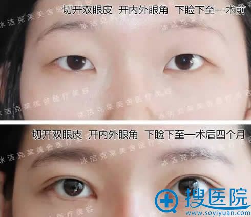 开眼角改变眼间距前后效果图 开眼角改变眼间距前后效果图
