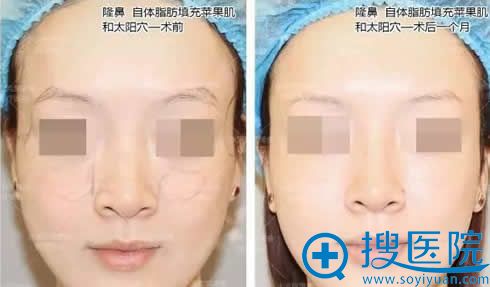 隆鼻改变眼间距的效果对比照片 隆鼻改变眼间距的效果对比照片