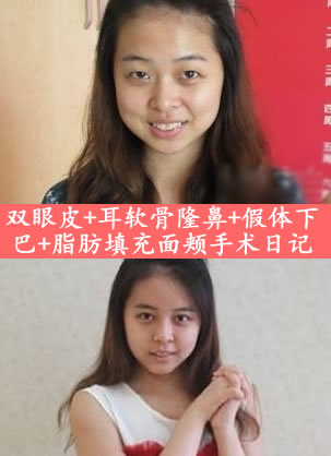 北京华韩整形医院钱建中手术案例 双眼皮+下巴+鼻子一步到位