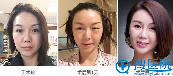 <!--<i data=20240710 data-id=12503></i>-->整形美容医院4D线雕案例 <!--<i data=20240710 data-id=12503></i>-->整形美容医院4D线雕案例