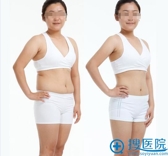 <!--<i data=20240710 data-id=12503></i>-->整形美容医院全身吸脂案例 <!--<i data=20240710 data-id=12503></i>-->整形美容医院全身吸脂案例