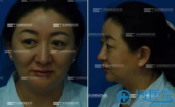 深圳鹏程王继红线雕“齿托三剑客”真人案例 找回10年青春