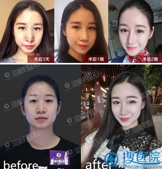 广州海峡黄金三角希望鼻恢复效果 广州海峡黄金三角希望鼻恢复效果