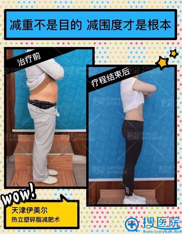 【真人案例】天津伊美尔热立塑帮你躺着瘦成小腰精 暑期5折优惠