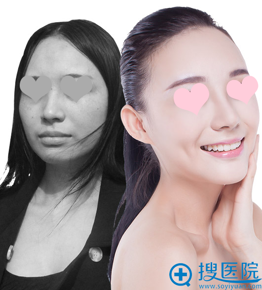 上海美莱2017暑期学生整形优惠价格表 杜园园埋线双眼皮688元