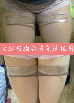 北京冯立哲整形医院张志义新案例出炉 大腿吸脂后恢复过程图