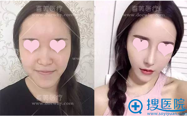 上海喜美整形医院鼻综合整形案例 上海喜美整形医院鼻综合整形案例