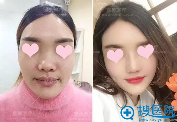 上海喜美整形医院全脸脂肪填充对比案例 上海喜美整形医院全脸脂肪填充对比案例