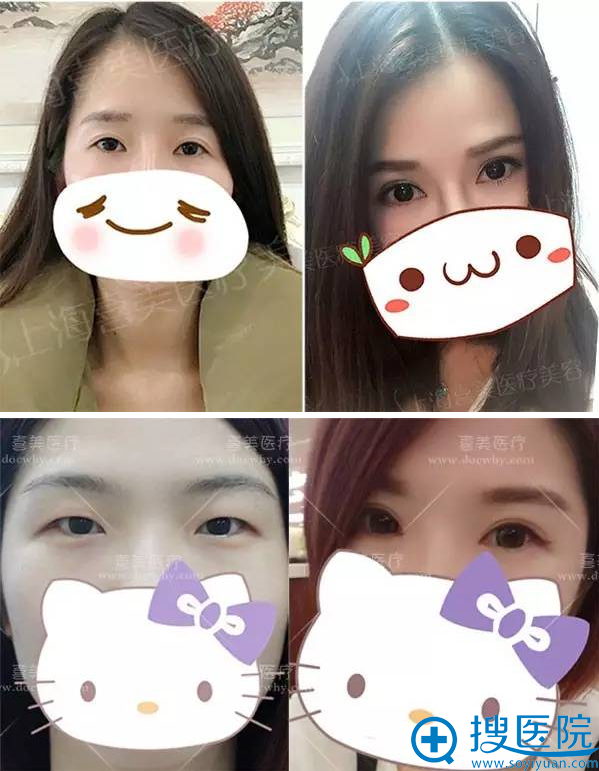 上海喜美整形医院双眼皮真人对比案例 上海喜美整形医院双眼皮真人对比案例