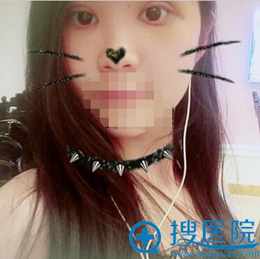 术后7天拆线了 术后7天拆线了