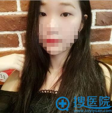 双眼皮+开眼角术前照片 双眼皮+开眼角术前照片