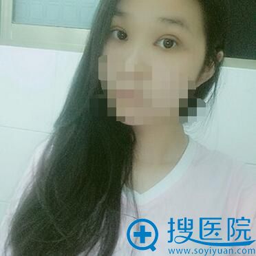 术后15天,眼睛还是有点肿 术后15天,眼睛还是有点肿