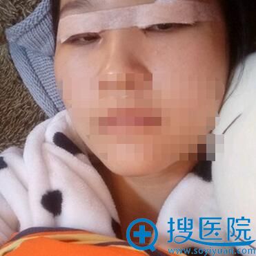 双眼皮+开眼角术后即刻 双眼皮+开眼角术后即刻
