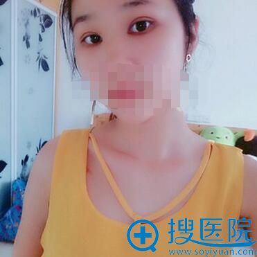 双眼皮+开眼角术后1个月恢复照片 双眼皮+开眼角术后1个月恢复照片