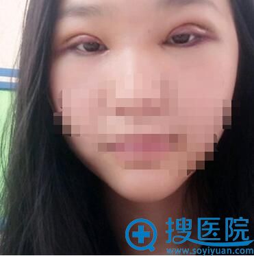 术后天,眼睛肿的像“肉条” 术后天,眼睛肿的像“肉条”