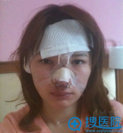 做完鼻修复手术时候照片_<!--<i data=20240710 data-id=14090></i>-->整形 做完鼻修复手术时候照片_<!--<i data=20240710 data-id=14090></i>-->整形