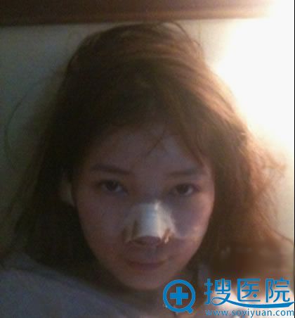 罗汇东做完鼻修复手术第3天 罗汇东做完鼻修复手术第3天