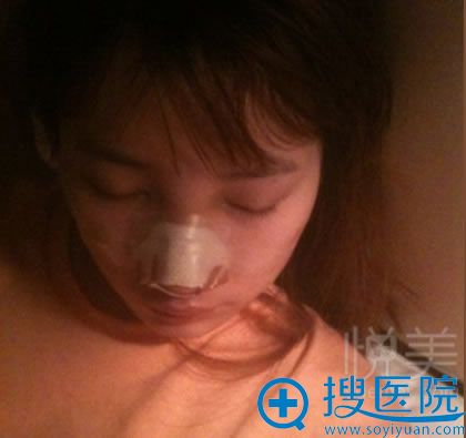 <!--<i data=20240710 data-id=14090></i>-->整形鼻修复手术第4天 <!--<i data=20240710 data-id=14090></i>-->整形鼻修复手术第4天