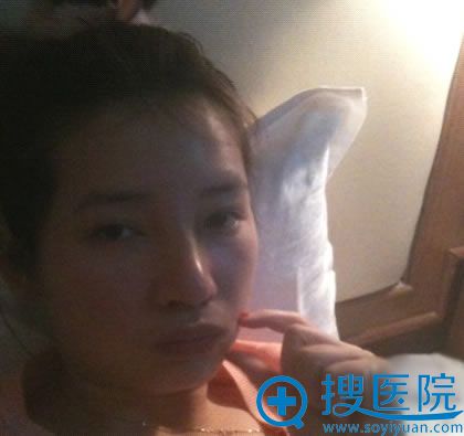 <!--<i data=20240710 data-id=14090></i>-->整形医院鼻修复手术5天 <!--<i data=20240710 data-id=14090></i>-->整形医院鼻修复手术5天