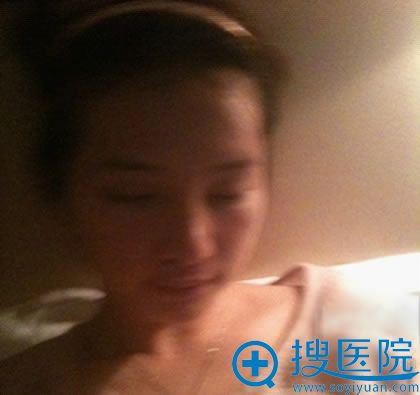 罗汇东鼻修复手术第6天效果 罗汇东鼻修复手术第6天效果
