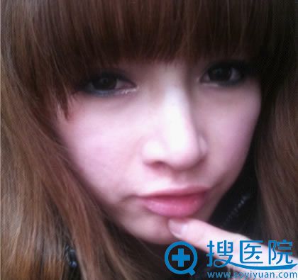 隆鼻手术恢复后化妆后照片 隆鼻手术恢复后化妆后照片