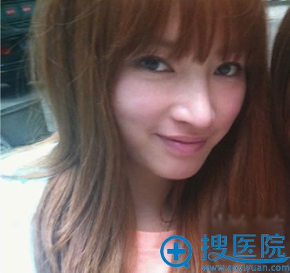 隆鼻手术恢复后化妆前照片 隆鼻手术恢复后化妆前照片