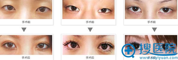 <!--<i data=20240710 data-id=8322></i>-->眼部整形前后对比照 <!--<i data=20240710 data-id=8322></i>-->眼部整形前后对比照