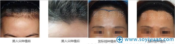 <!--<i data=20240710 data-id=8322></i>-->整形外科毛发种植效果图 <!--<i data=20240710 data-id=8322></i>-->整形外科毛发种植效果图