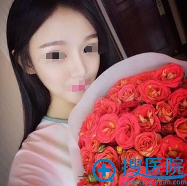 朱灿耳软骨鼻综合术后29天,效果非常自然 朱灿耳软骨鼻综合术后29天,效果非常自然