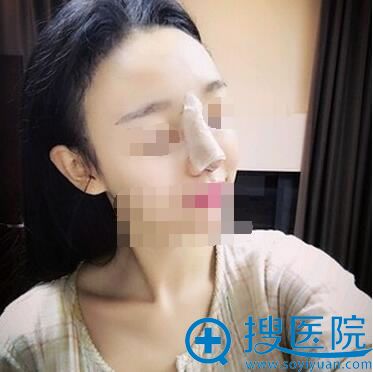 鼻综合术后即刻效果 鼻综合术后即刻效果