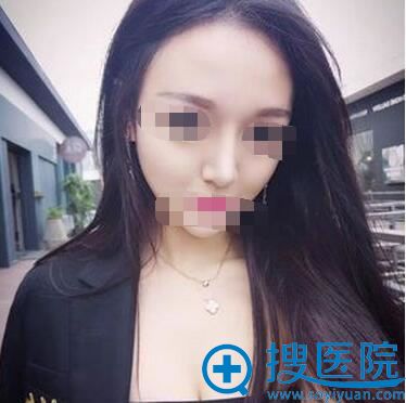 耳软骨鼻综合术后8天消肿 耳软骨鼻综合术后8天消肿