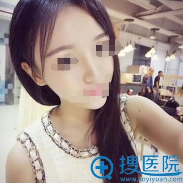 术后22天,已经可以揉捻鼻子了 术后22天,已经可以揉捻鼻子了
