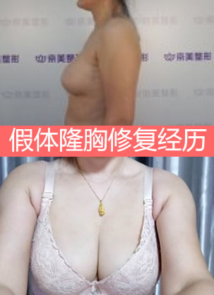 隆胸失败修复第三次手术经历 北京京美刘成胜帮我解决20年烦恼