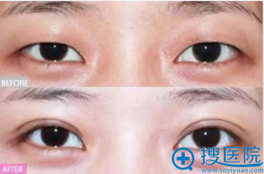 宁波美莱双眼皮之肿眼泡改善案例 宁波美莱双眼皮之肿眼泡改善案例