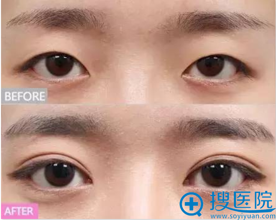 宁波美莱双眼皮之眼裂狭窄改善案例 宁波美莱双眼皮之眼裂狭窄改善案例