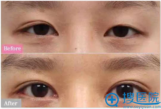 宁波美莱双眼皮之一单一双改善案例 宁波美莱双眼皮之一单一双改善案例
