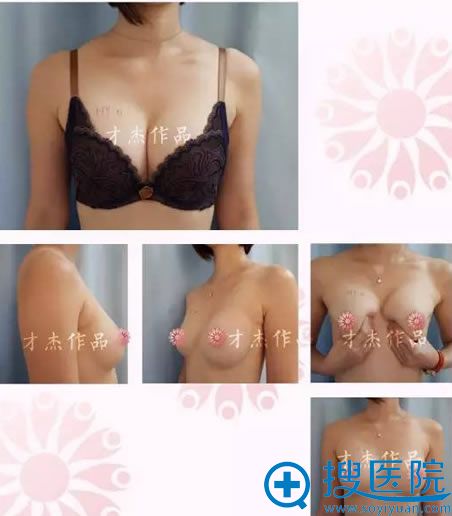 谢亮隆胸作品图 谢亮隆胸作品图