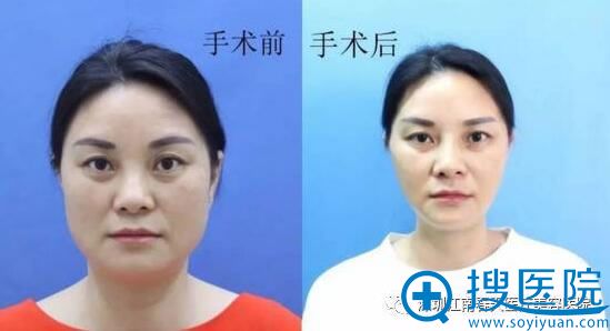 童颜线雕手术前后对比图。 童颜线雕手术前后对比图。