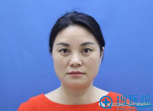 深圳春天医院崔永芳线雕提升前后对比照片 视频揭秘手术过程