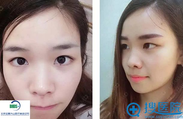 学生整形前后效果对比照片 学生整形前后效果对比照片