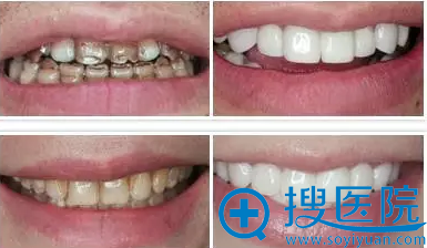 杭州时光牙贴面案例对比 杭州时光牙贴面案例对比