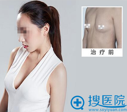 胸部整形 胸部整形