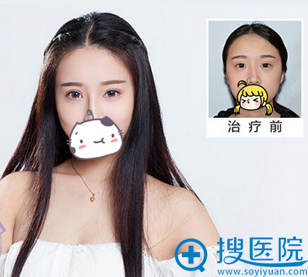 韩式双眼皮、注射隆鼻、垫下巴 韩式双眼皮、注射隆鼻、垫下巴