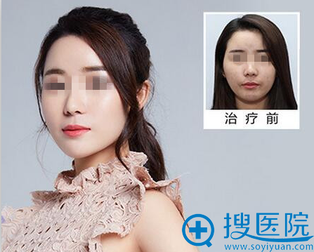 瘦脸、去痘印、字体脂肪面部填充 瘦脸、去痘印、字体脂肪面部填充