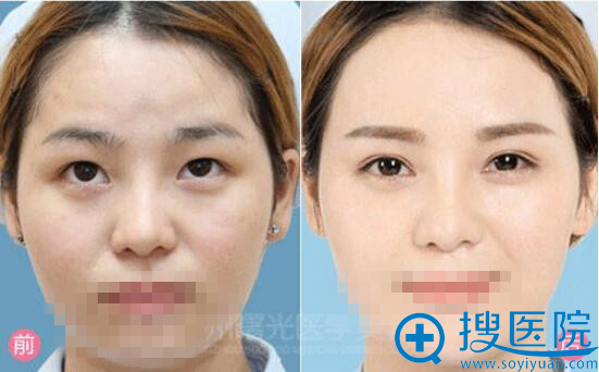 双眼皮对比图 双眼皮对比图