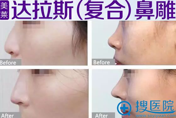 成都美莱隆鼻真实案例 成都美莱隆鼻真实案例