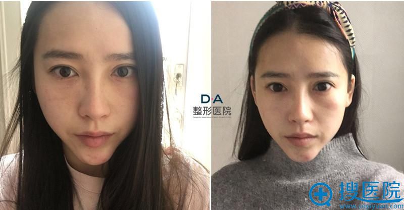 韩国DA整形外科医院V line+脂肪移植术后三个月日记