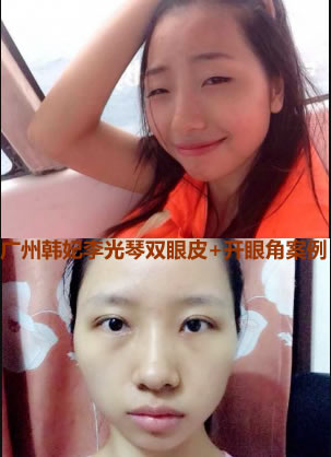 广州韩妃李光琴切开双眼皮+开眼角真实案例 瞬变天生大媚眼